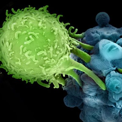 cáncer triple negativo, sistema inmune, tratamiento inmune, tratamiento de cáncer, quimioterapia, inmunoterapia, enfermedad agresiva